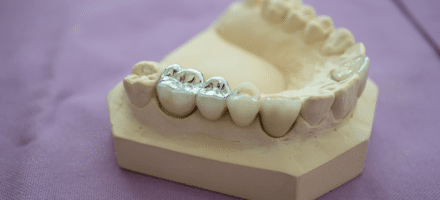 Dental model of bottom jaw with silver fillings.